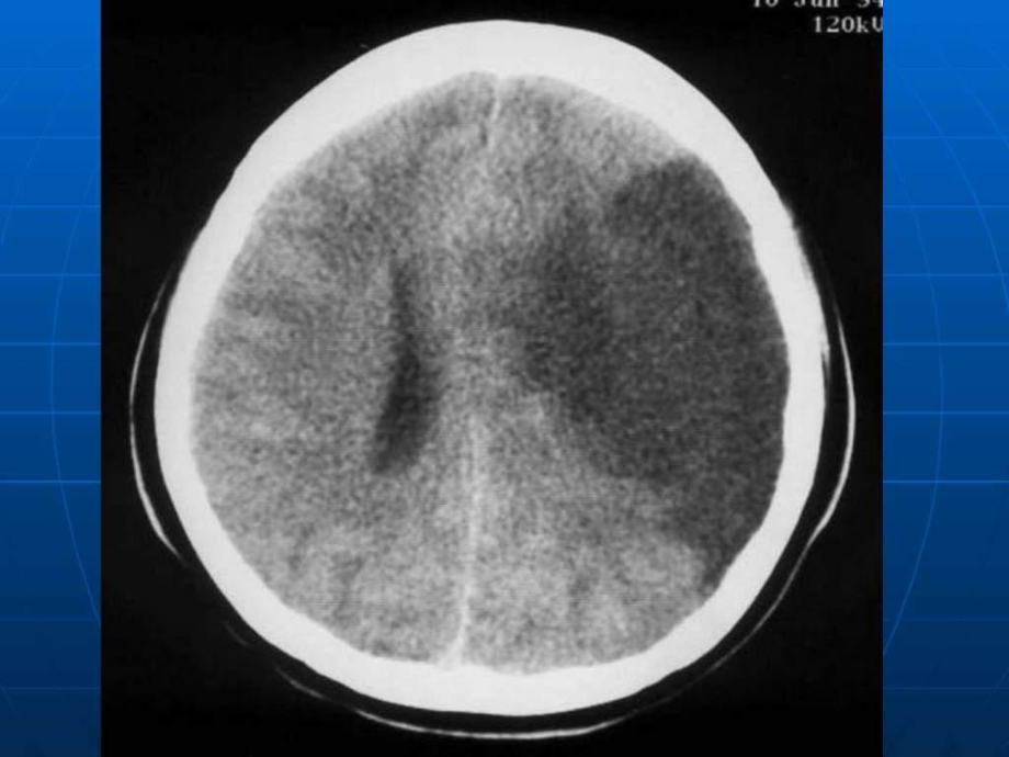脑梗死与颅内出血出血ct影像ppt
