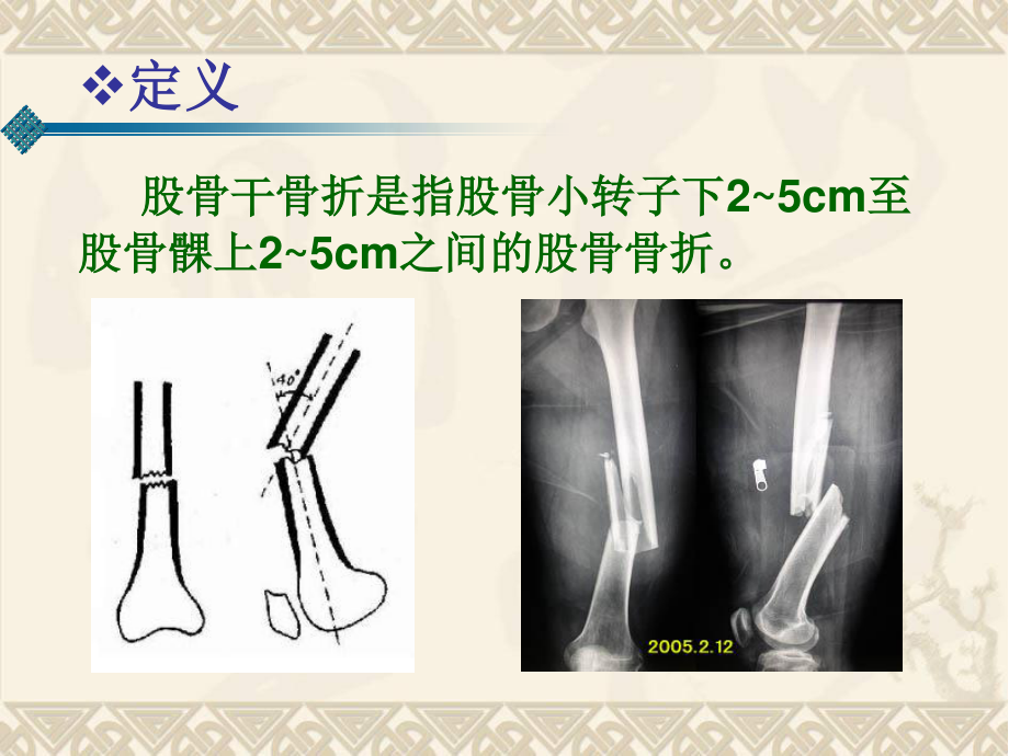 股骨幹骨折ppt課件