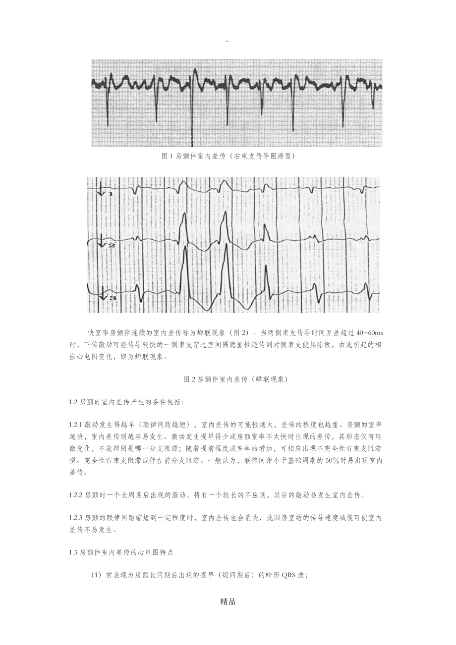 房颤时室早及室内差传的特点与鉴别