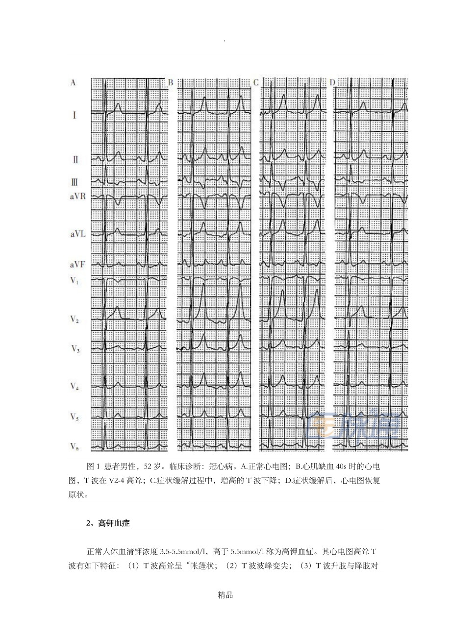 高聳t波的九種情況及心電圖特徵