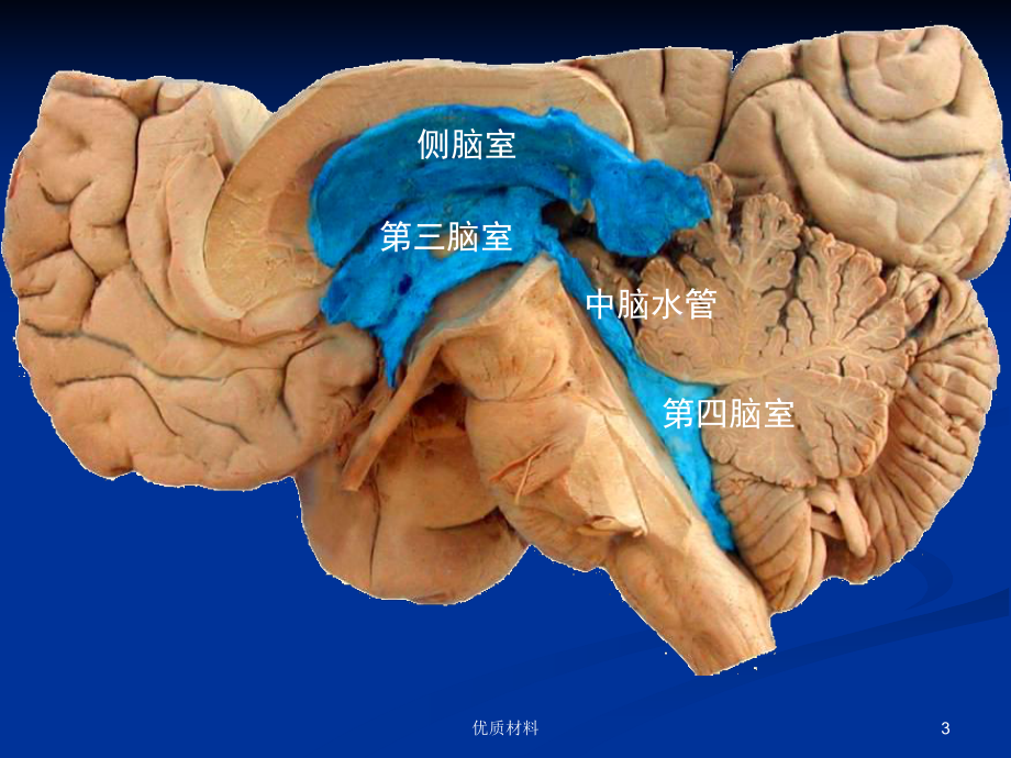 侧脑室 第三脑室图片