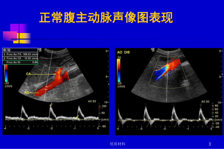 腹膜后大血管超声优质借鉴