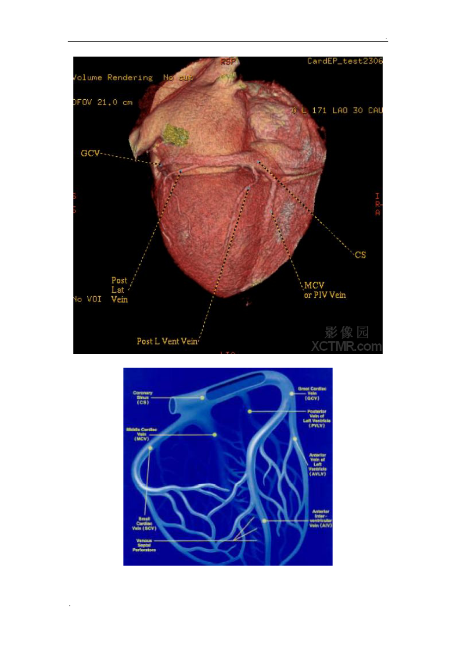 心臟冠狀動脈ct解剖中文詳細標註圖文