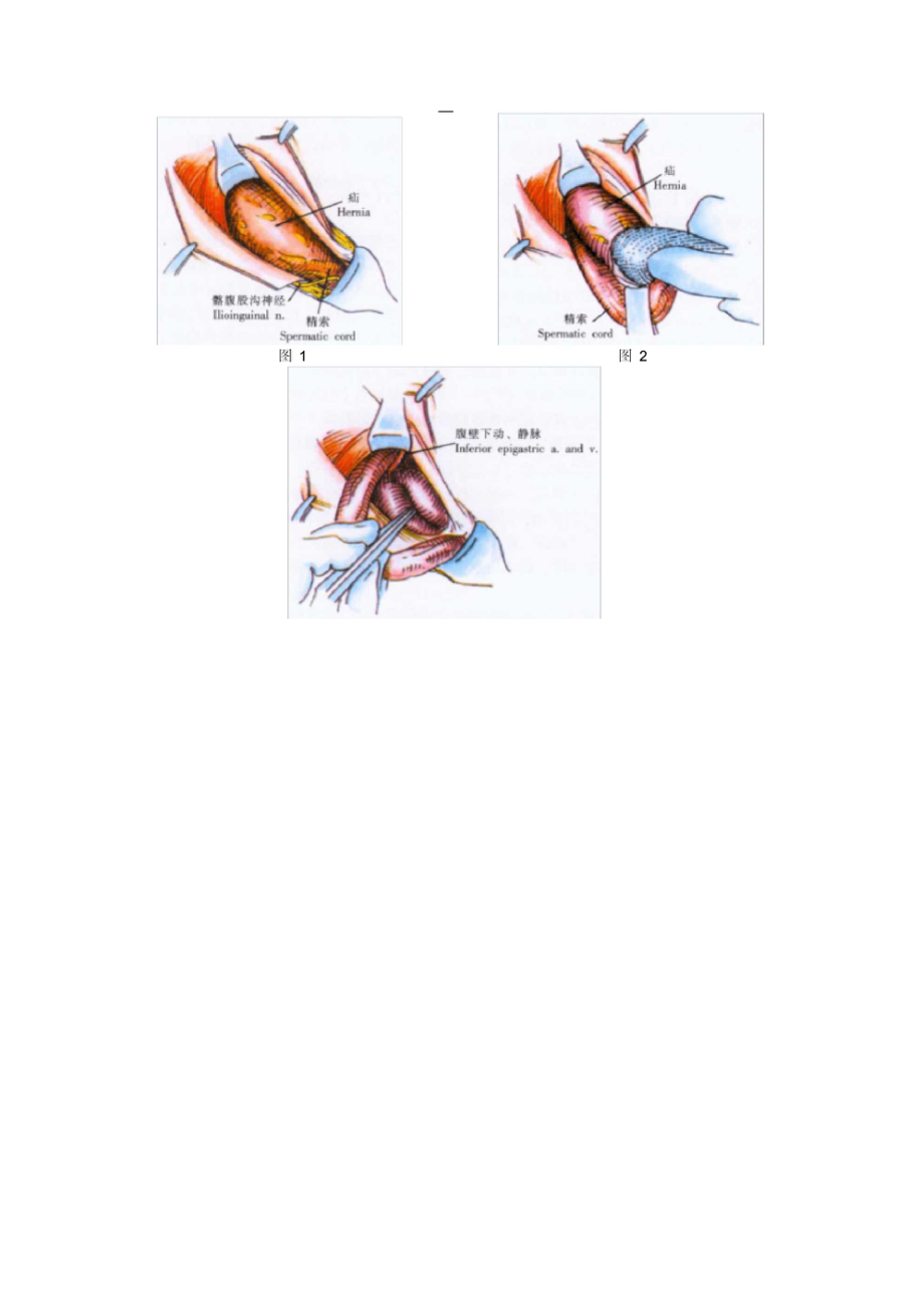 股疝手术步骤图解图片