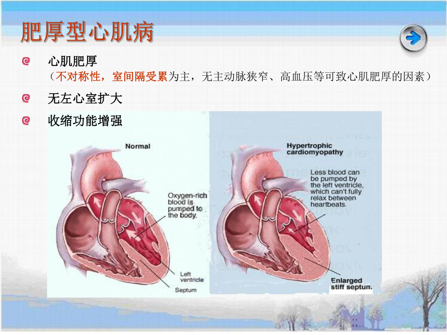 向心性肥厚图片