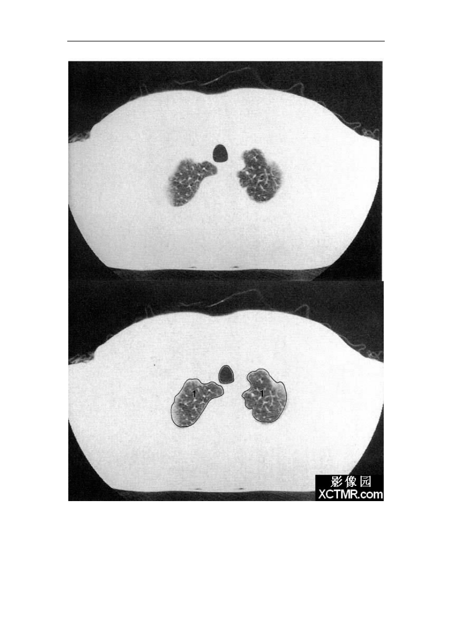 肺部正常CT图像解剖_第1页