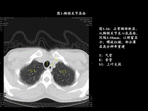 胸部ct解剖及典型病例CT征象