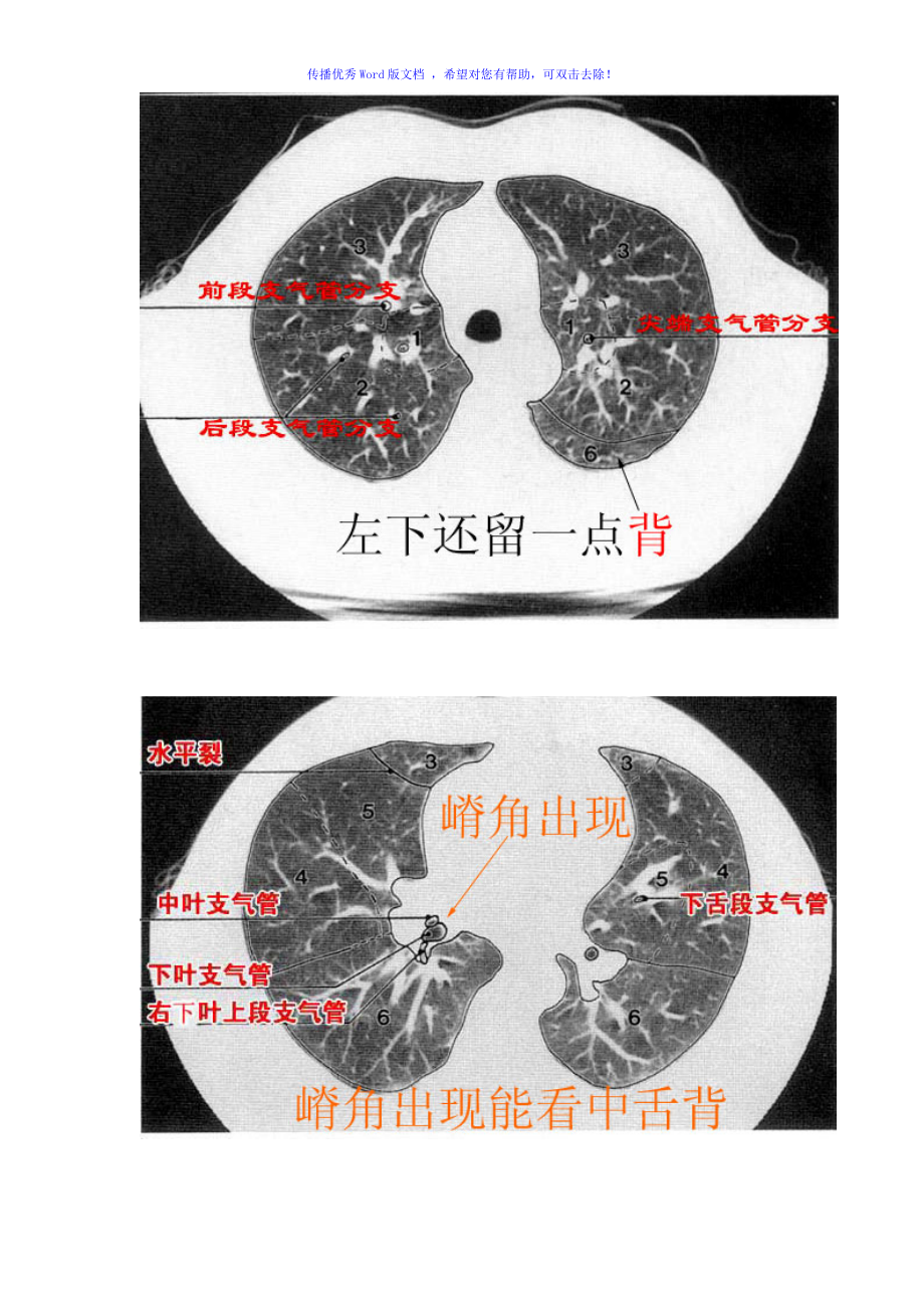 肺段划分ct图片