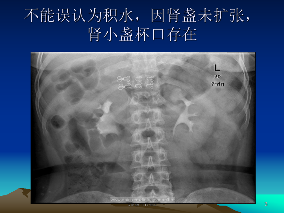 壺腹型腎盂課件