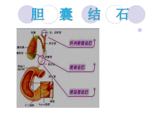 《膽囊結(jié)石護(hù)理》PPT課件