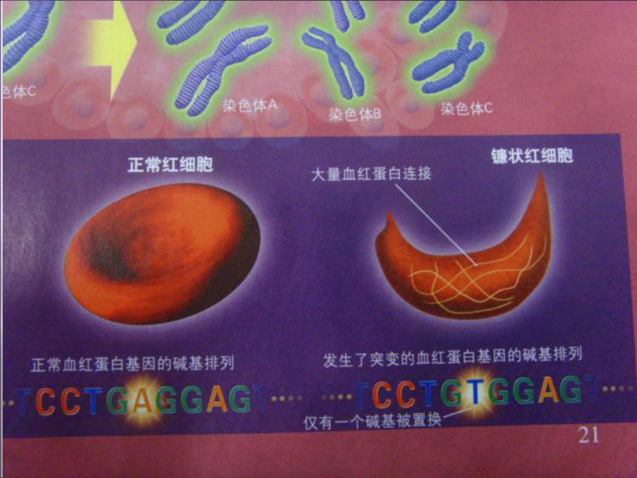 镰刀型细胞贫血症症状图片
