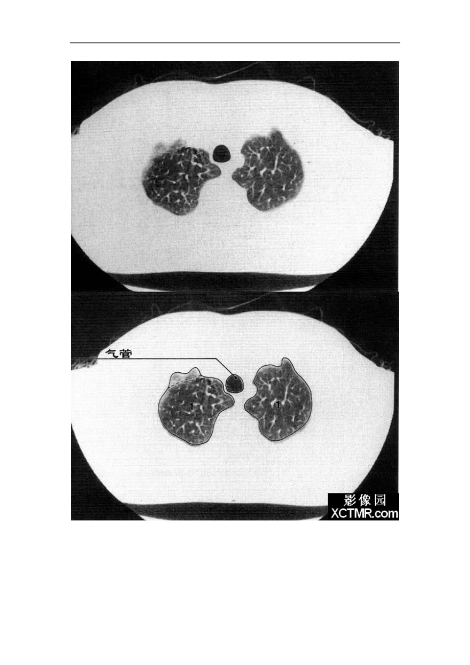 正常人肺部ct图片