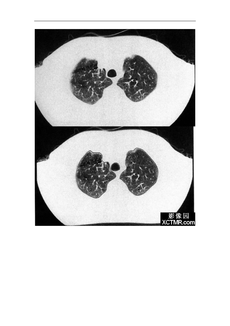正常肺部片子图片图片