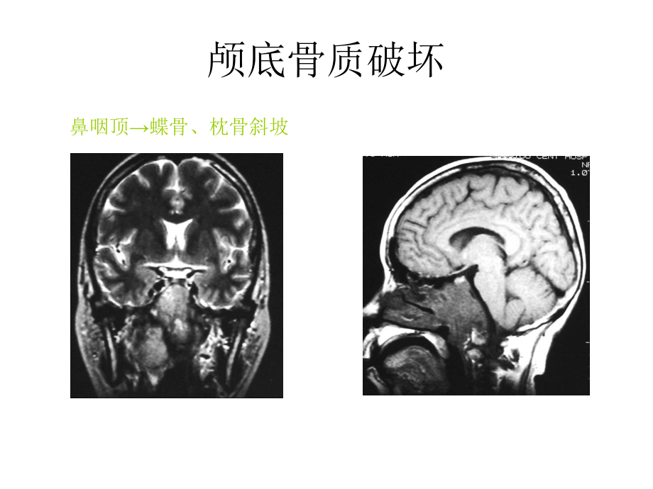 颅底骨质破坏2pt课件_第1页