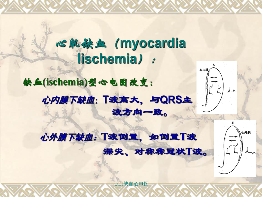 心肌缺血心电图_第1页