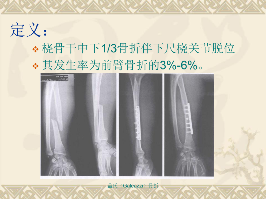 盖氏galeazzi骨折