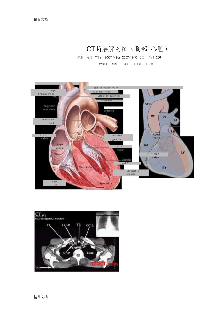 CT断层解剖图(胸部-心脏)_第1页