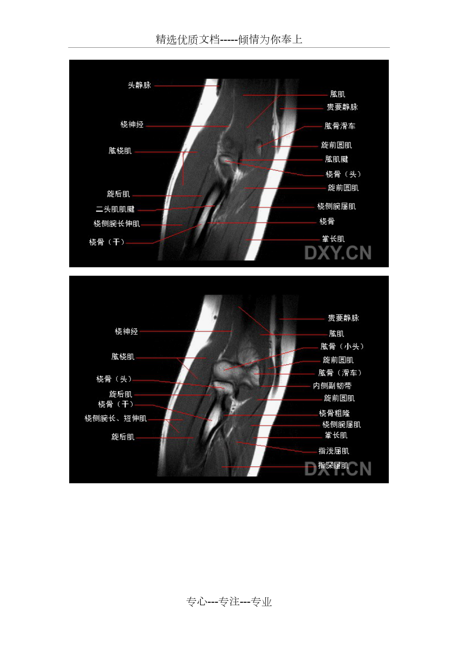 盂肱韧带mri解剖图片