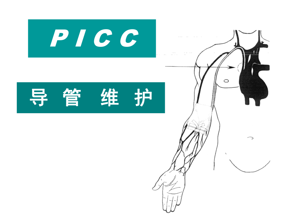 PICC导管维护_第1页