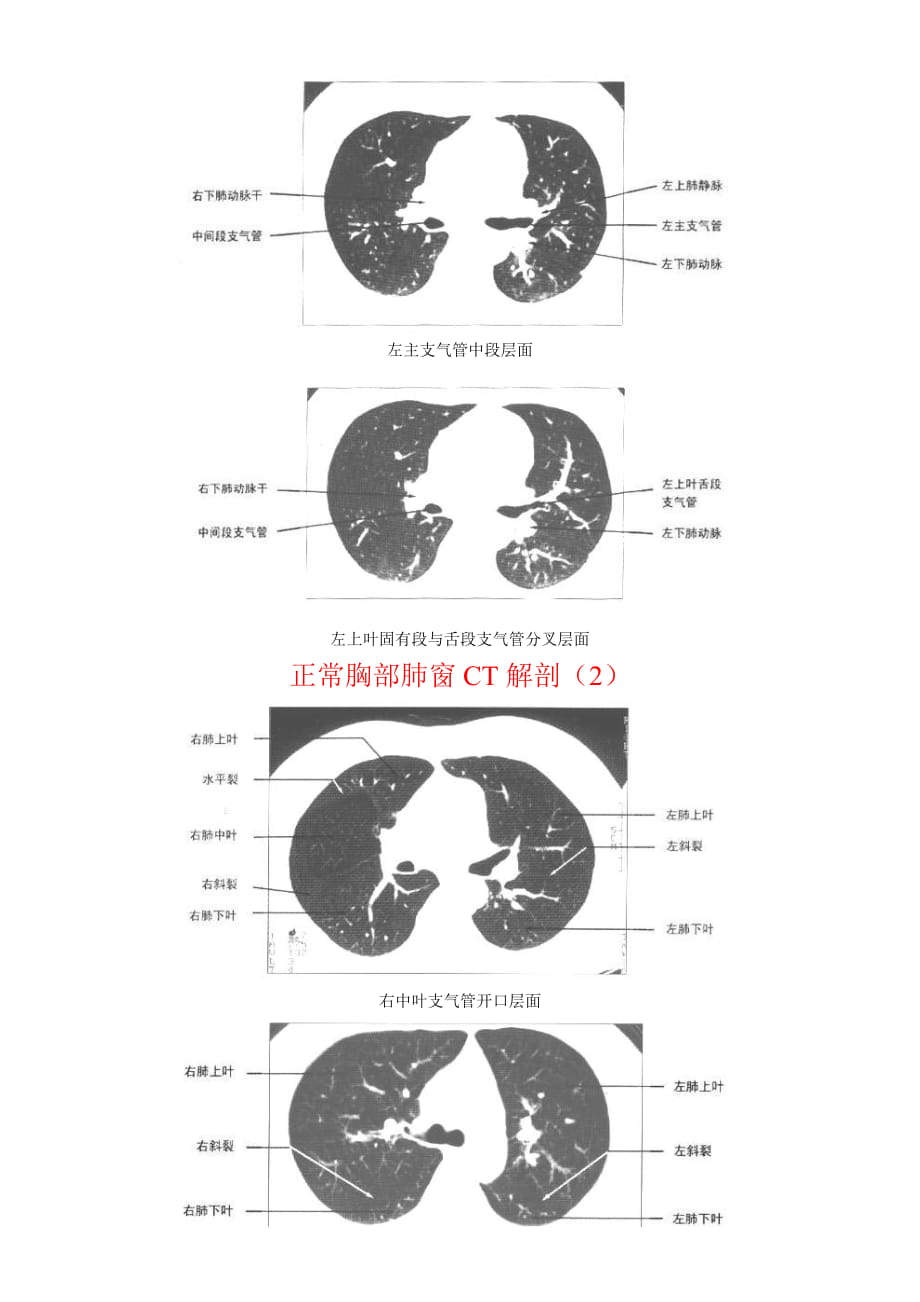 正常胸部ct肺窗和纵隔窗