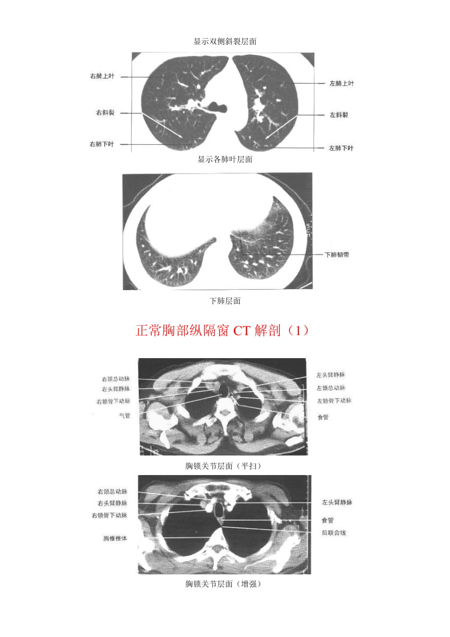 肺窗和纵膈窗图片