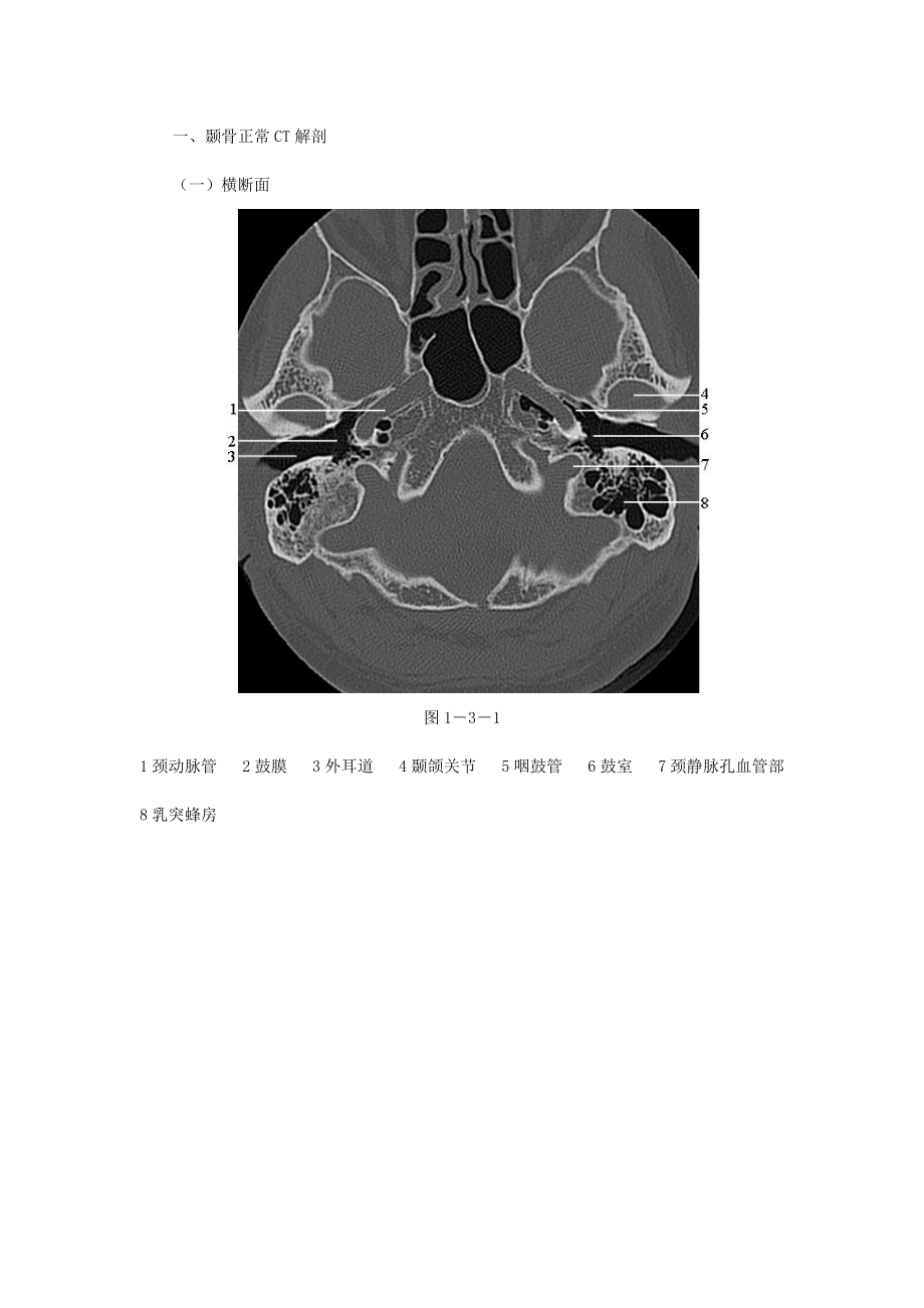 颞骨岩部ct解剖图图片