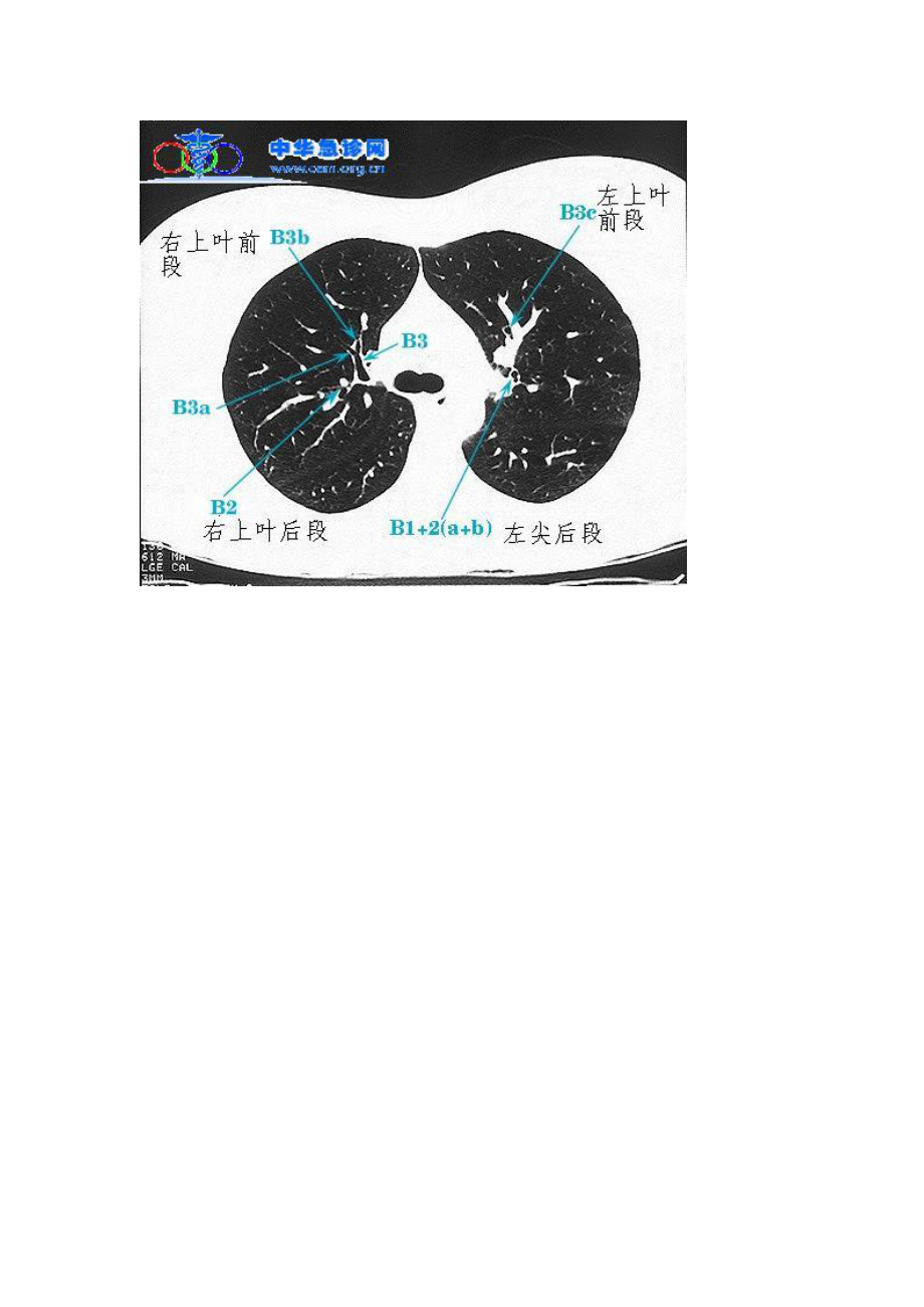肺的分叶分段的ct图图片