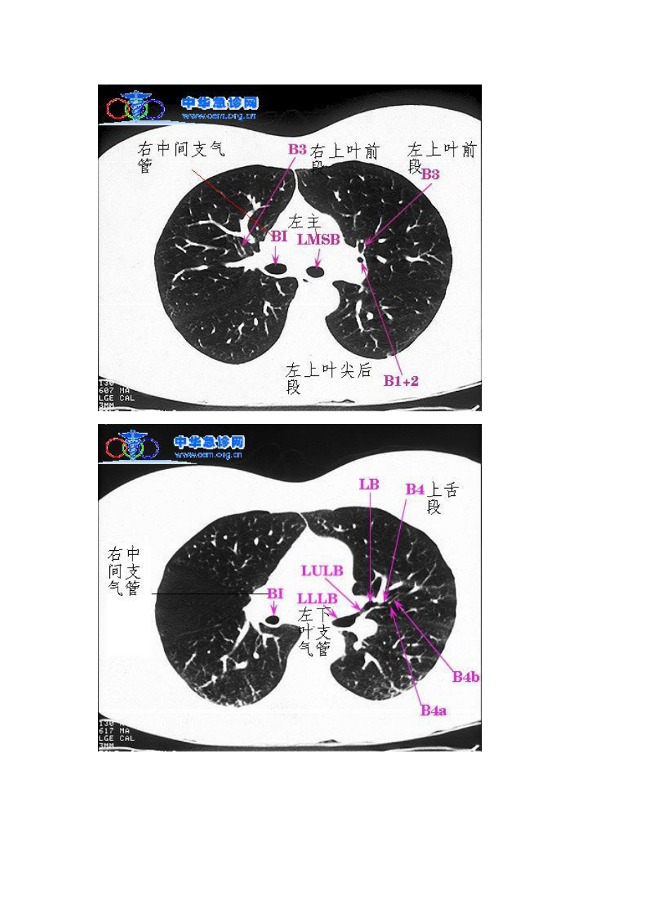 正常肺部ct图解图片