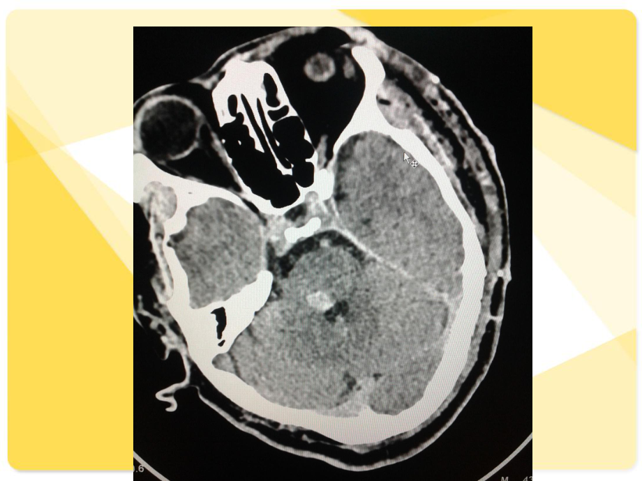 腦幹海綿狀血管瘤mri