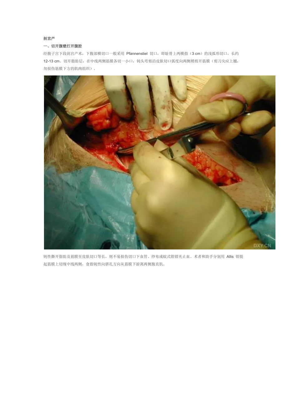 剖宫产手术流程含图