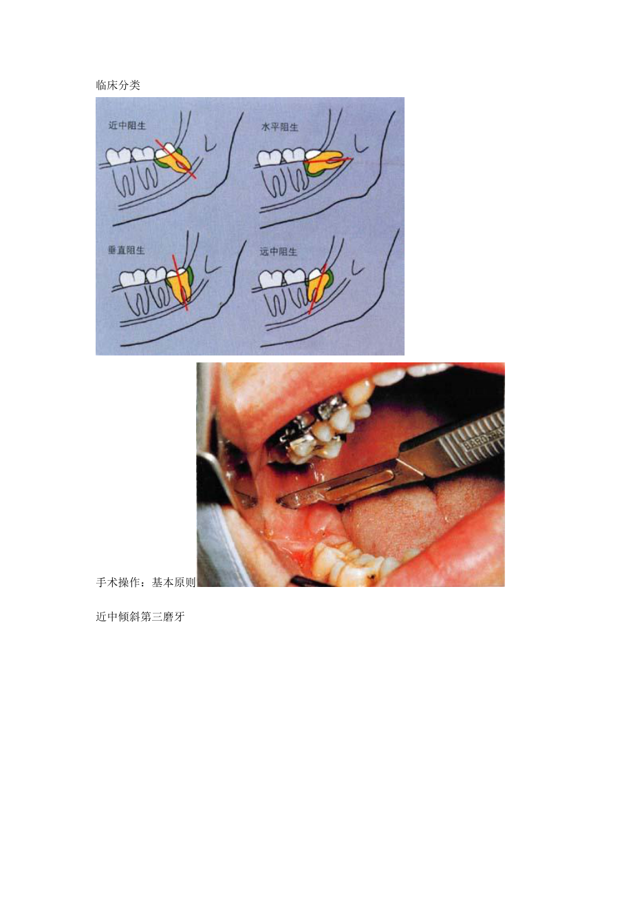 阻生第三磨牙拔除_第1頁