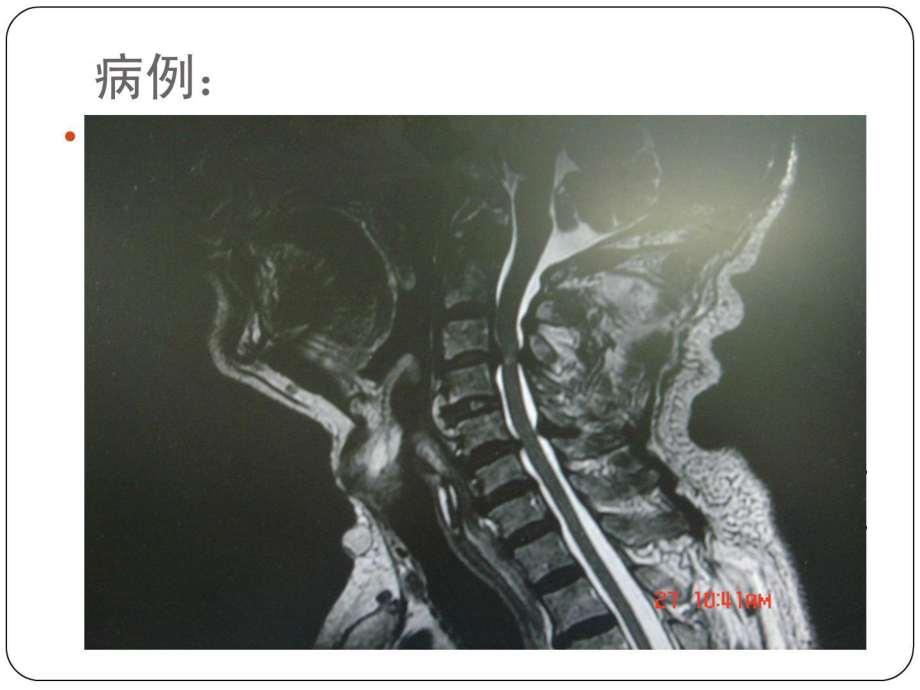 《精彩颈椎病康复》PPT课件_第1页