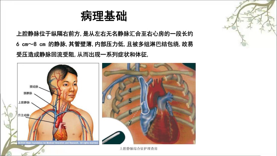 上腔静脉压迫图片