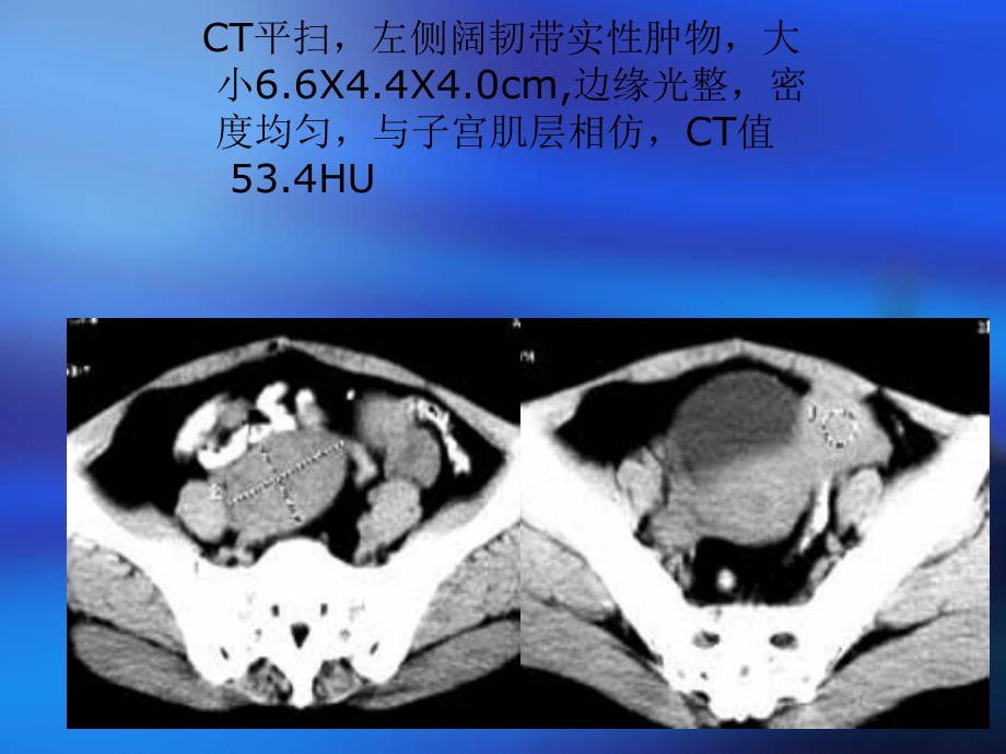 ct在女性生殖系统的应用