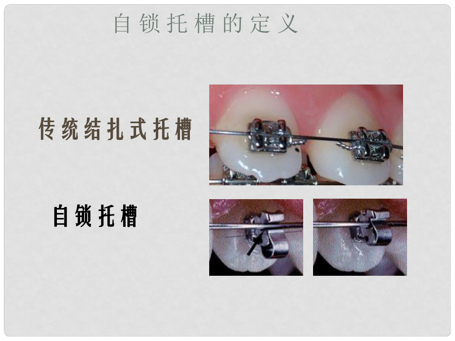 普通托槽和自锁托槽图片