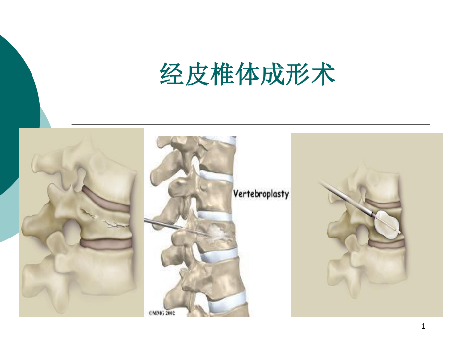 （優(yōu)質(zhì)課件）經(jīng)皮椎體后凸成形術_第1頁