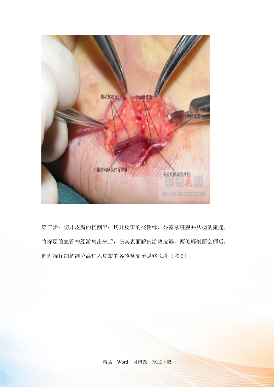 腹部皮瓣手术图解图片