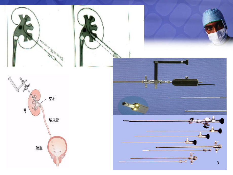 经皮肾镜手术讲解ppt演示课件