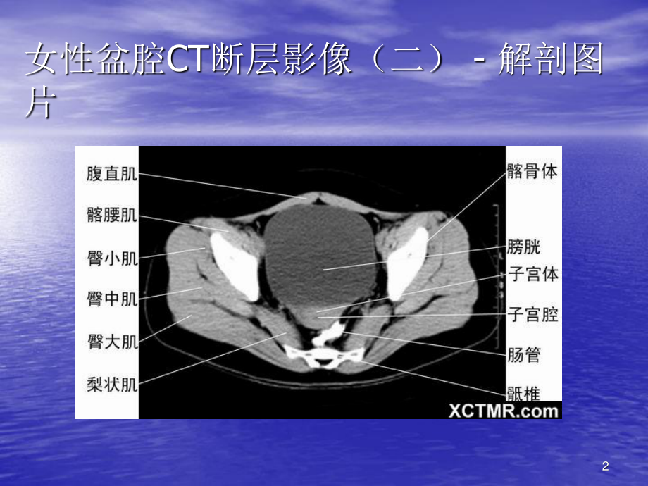 女性盆腔CT图解图片