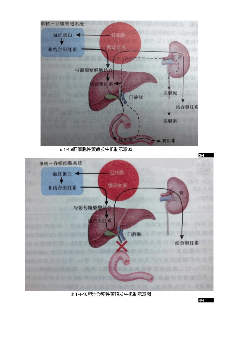 胆红素正常代谢示意图图片