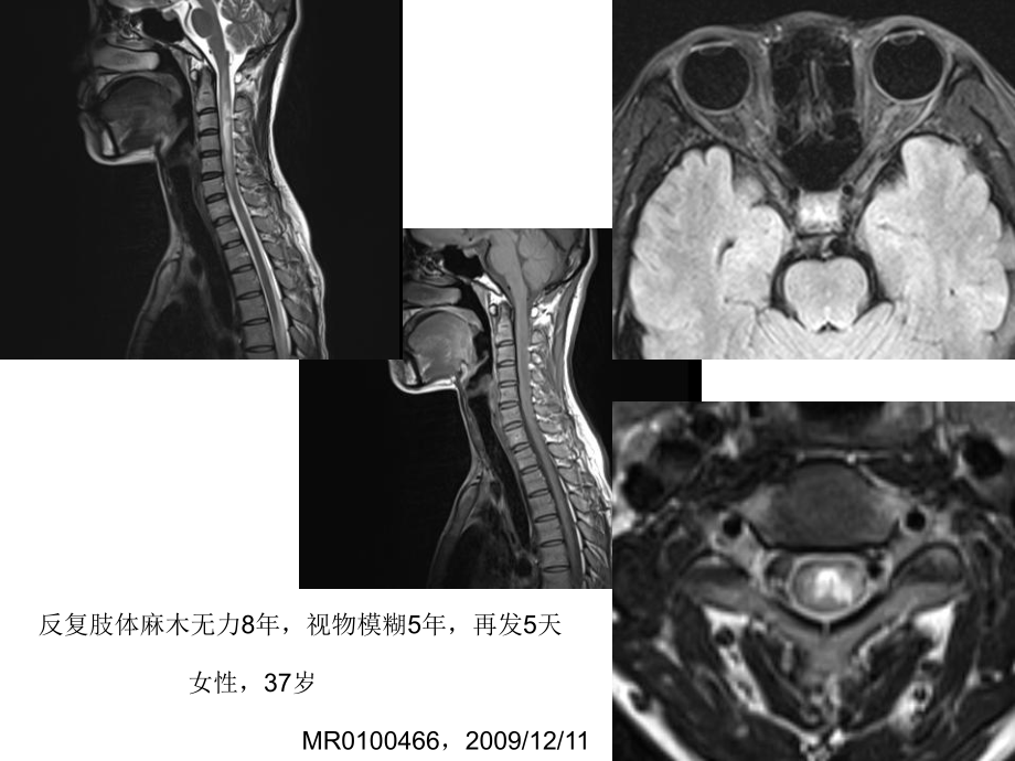 視神經(jīng)脊髓炎的MR診斷培訓講座課件PPT_第1頁