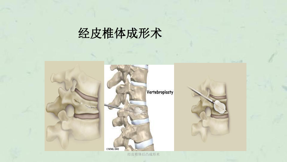 經(jīng)皮椎體后凸成形術課件_第1頁