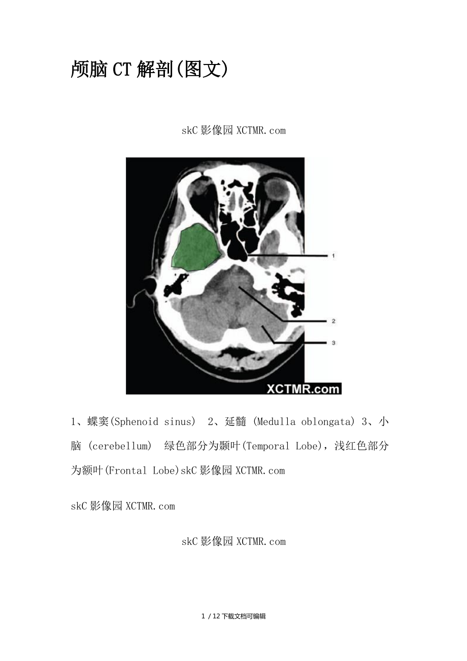 颅脑CT解剖带图解_第1页