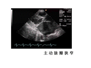 南昌大学超声精品课程之心脏瓣膜病之二