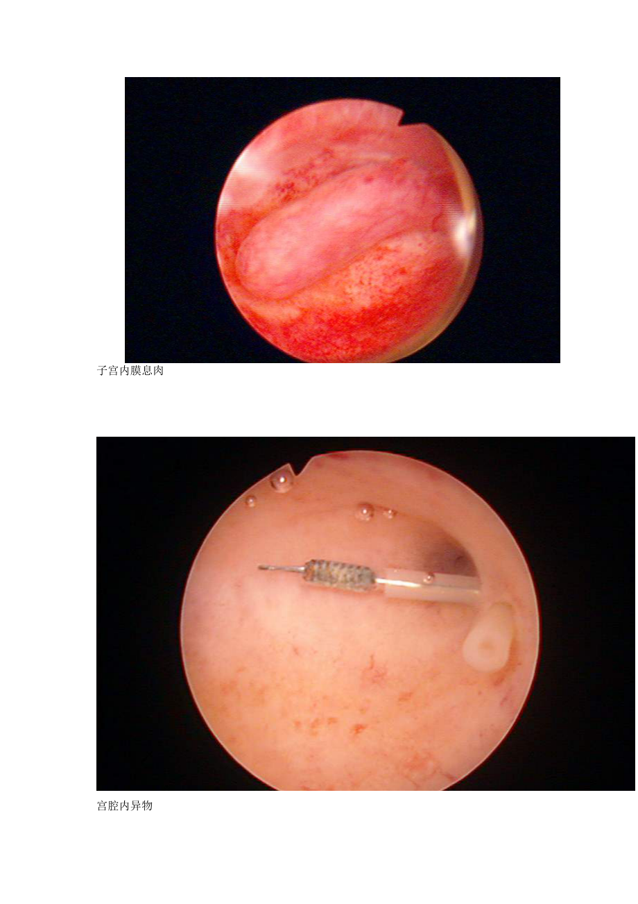 几张宫腔镜图片